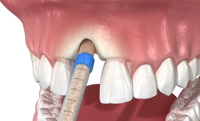 bone grafting & reconstruction treatment