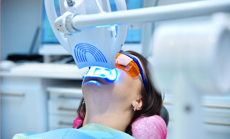 In office Chairside teeth Whitening