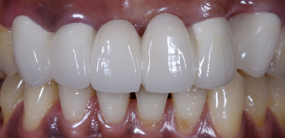 after bone grafting picture