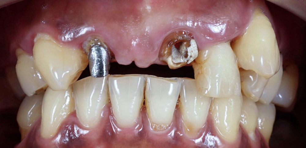 before bone grafting picture