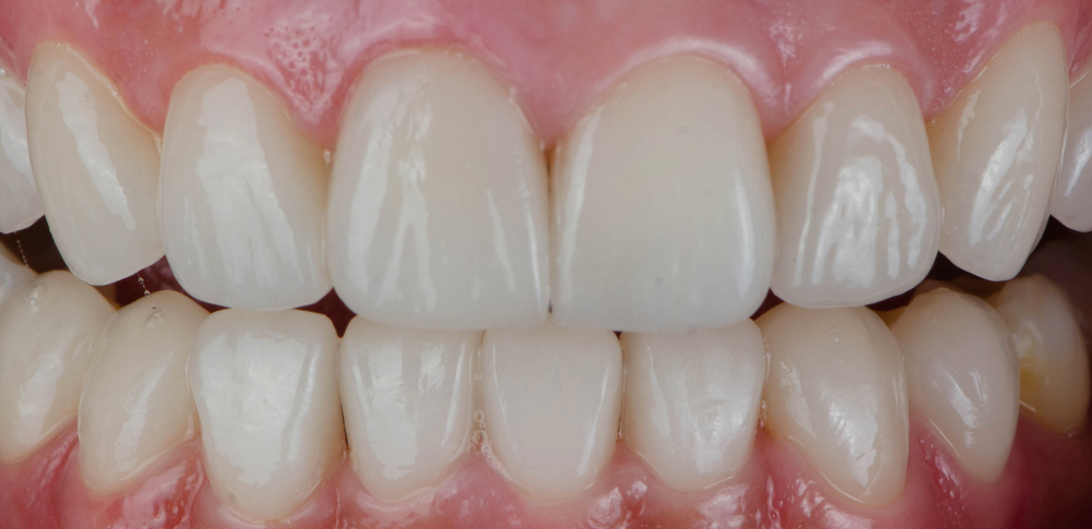 after gum treatment picture