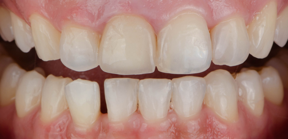 before gum treatment picture