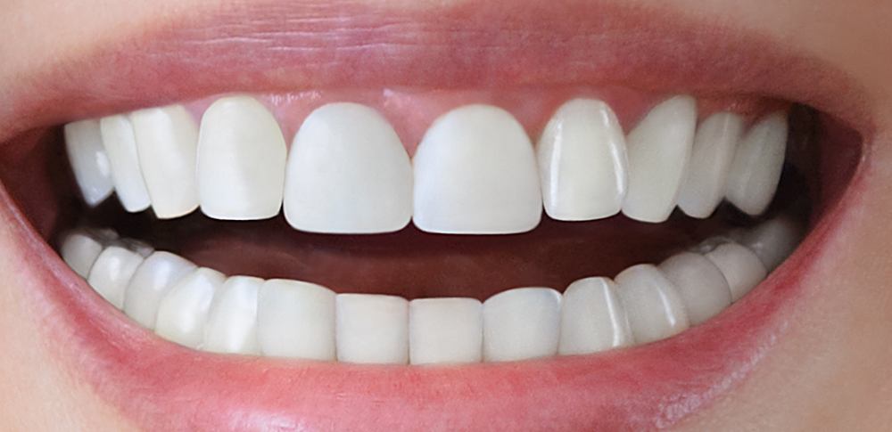 after restorative picture