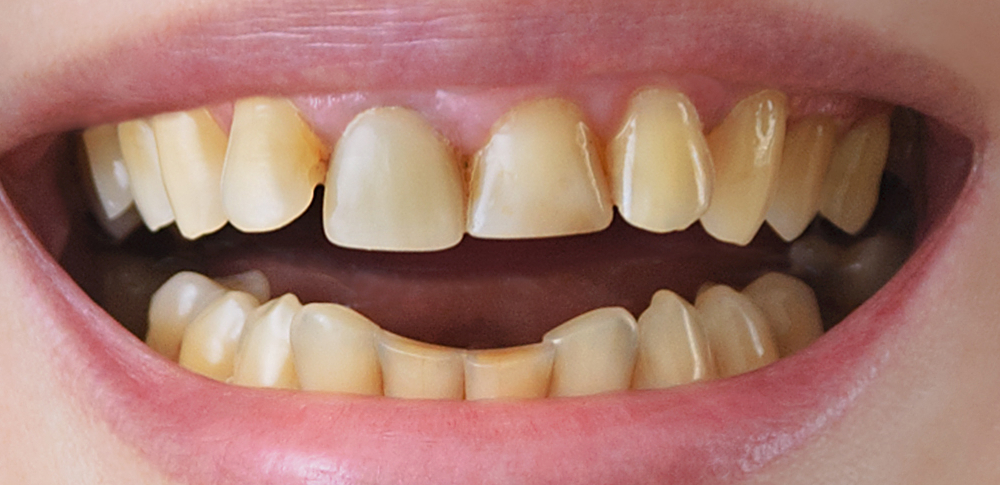 before restorative picture