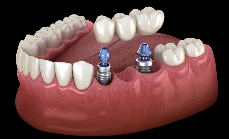 implant-supported bridge
