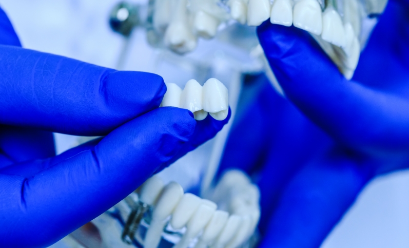 dental bridges treatment
