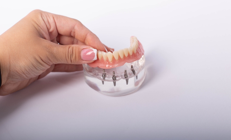 all-on-4 dental implants