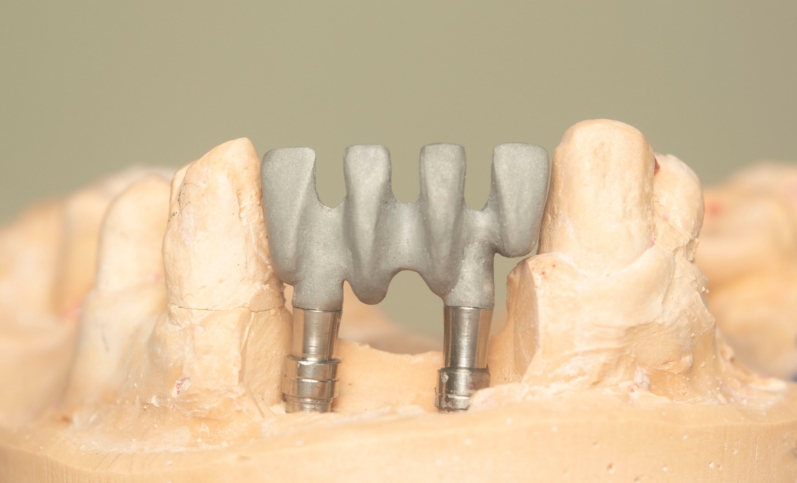 PFM dental crowns