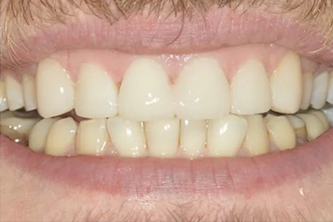after restorative dentistry picture