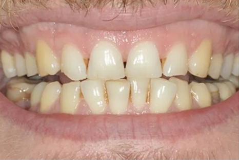 before restorative dentistry picture