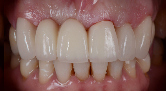 after dental bridges picture