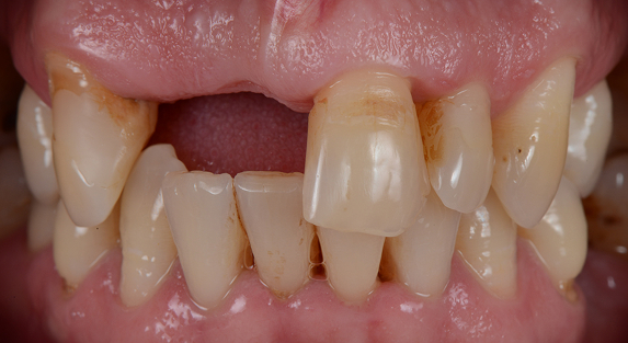 before dental bridges picture