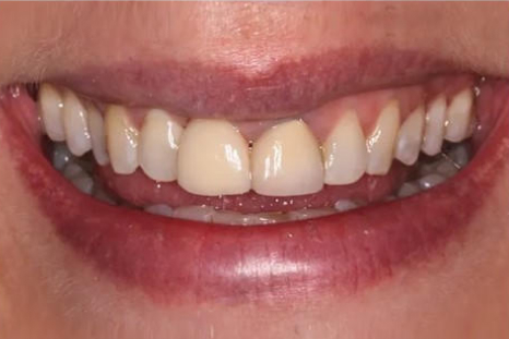 after dental implant picture