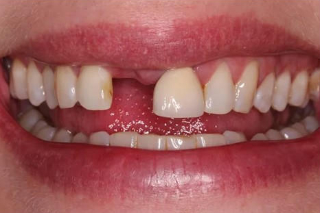 before dental implant picture