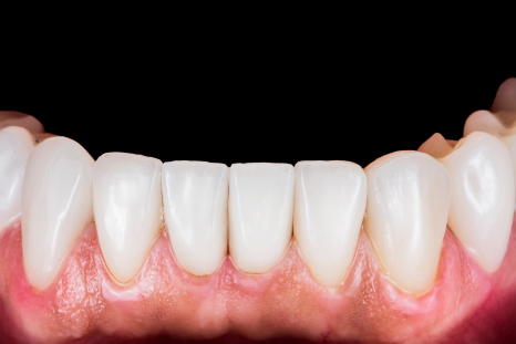 after dentures picture