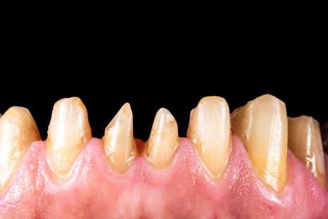 before dentures picture