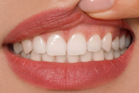 after laser gums treatment picture