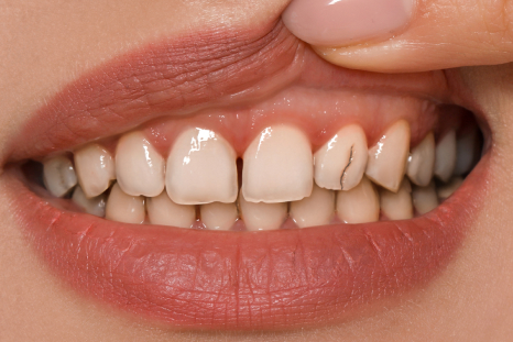 before laser gums treatment picture
