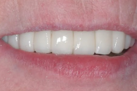 after all-on-4 dental implants picture