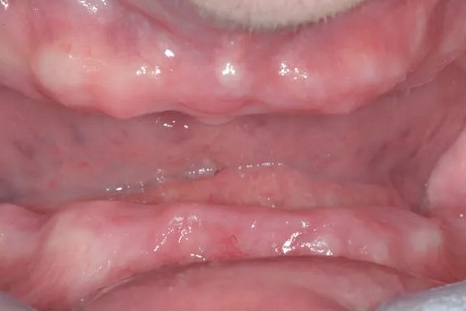 before all-on-4 dental implants picture