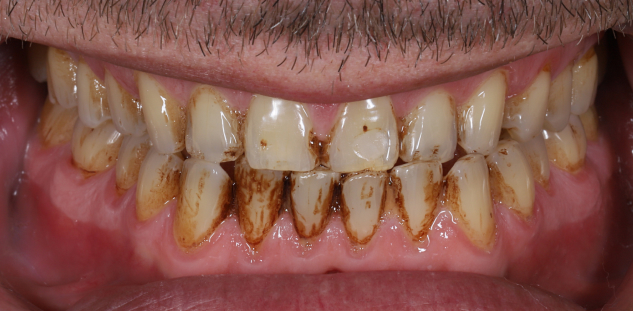 oral treatment before picture