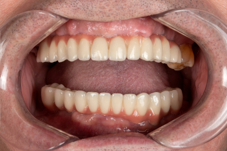 after implant-supported overdentures