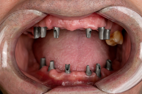 before implant-supported overdentures