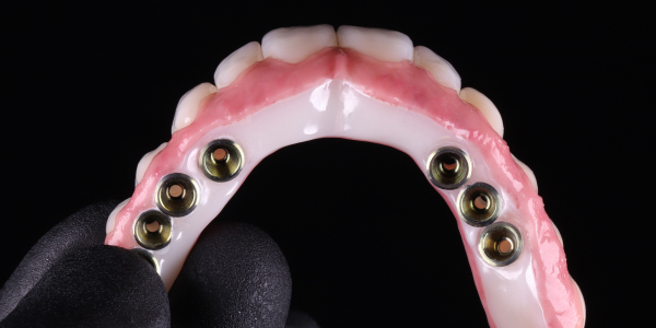 Implant-Supported Overdentures