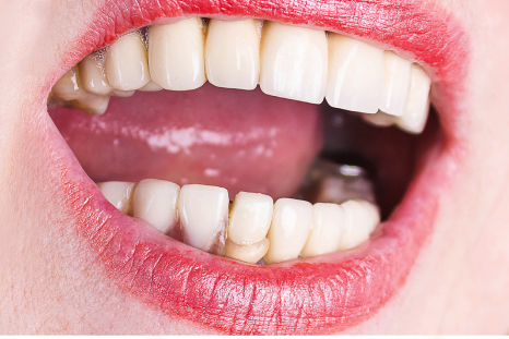 after partial denture picture
