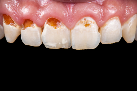 after PFM dental crowns picture