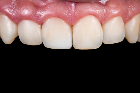 before PFM dental crowns picture