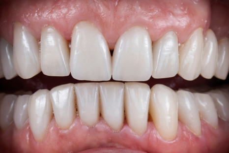 after porcelain dental picture