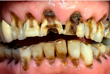 before porcelain dental picture