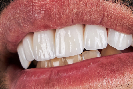 after single tooth implant picture