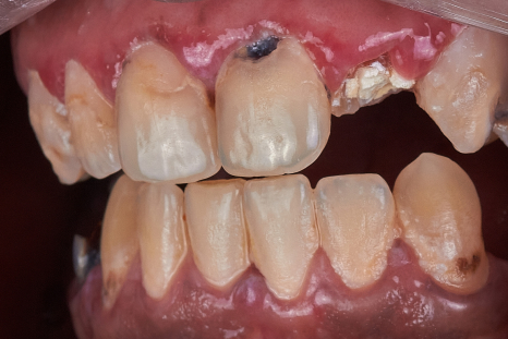 before single tooth implant picture