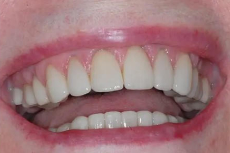 venner after picture