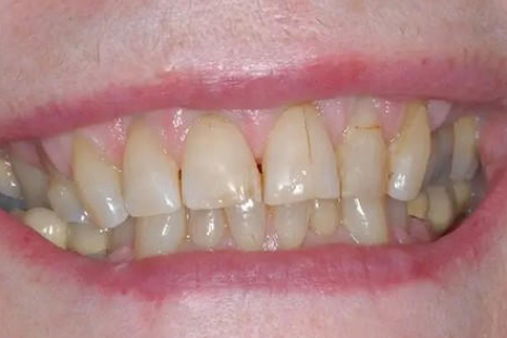 venner before picture